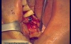 Immediate Implantation 14-18 (2/2)