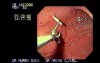 Percutaneous Endoscopic Gastrostomy (2 of 3)