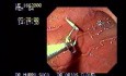 Percutaneous Endoscopic Gastrostomy (2 of 3)