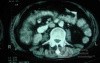 Pseudomembranous Colitis (9 of 11)