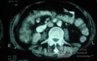 Pseudomembranous Colitis (9 of 11)