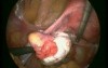 Ectopic Pregnancy
