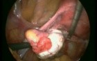 Ectopic Pregnancy