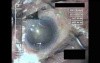Cataract Surgery VII - Part 2