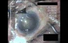Cataract Surgery VII - Part 2
