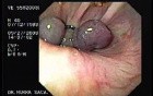Acute Variceal Bleeding - Ligation of Multiple Varices