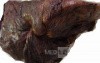 Lung Adenocarcinoma (4 of 5)