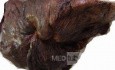 Lung Adenocarcinoma (4 of 5)