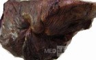 Lung Adenocarcinoma (4 of 5)