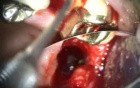 Dental Implant Microsurgery: Removal and Replacement