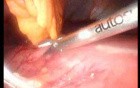 Gastrointestinal Stromal Tumor - GIST (20 of 65)