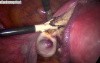 Laparoscopic Removal of The Uterus
