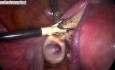 Laparoscopic Removal of The Uterus