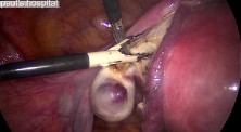 Laparoscopic Removal of The Uterus