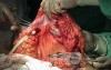 Metastasis of Renal Carcinoma to the ascending colon (7 of 11)