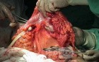 Metastasis of Renal Carcinoma to the ascending colon (7 of 11)