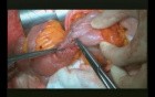 Right Open Hemicolectomy – Technical Principles - Part 6