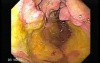 Gastroduodenal MALT lymphoma (8 of 9)