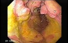 Gastroduodenal MALT lymphoma (8 of 9)