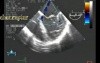 Infective Endocarditis: Chordal Rupture Of Both Mitral Leaflets With Severe Mitral Regurgitation - TEE