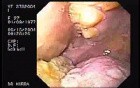 Oropharynge-Esophagic Candidiasis - Esophagitis (3 of 5)