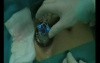 LESS Transvesical Removal of Mid-urethral Polypropylene Sling Eroded into the Bladder