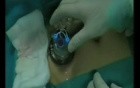 LESS Transvesical Removal of Mid-urethral Polypropylene Sling Eroded into the Bladder