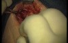 Rebuild Of Madnibular Implant Site (2/4)