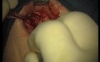 Rebuild Of Madnibular Implant Site (2/4)