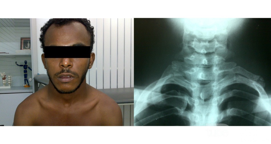 Cervical Ribs