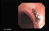 Tracheal Endoscopy - introduction through the fistula 4/5
