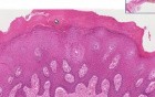 Mouth - Reactive Hyperkeratosis