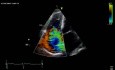 Tricuspid Valve Regurgitation
