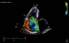 Tricuspid Valve Regurgitation