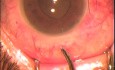 Fugo Blade - Use To Glaucoma Surgery
