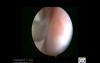 TVL endometriosis