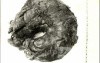 Paratesticular tumor