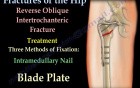 Hip Fractures and Fixation