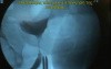 Male Sling Procedure For Urinary Incontinence