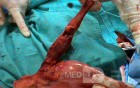 Barrett Adenocarcinoma - Endoscopic Image (14 of 20)