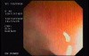 Tubulo - Villous Adenoma - Endoscopy (4 of 28)