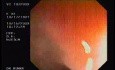 Tubulo - Villous Adenoma - Endoscopy (4 of 28)