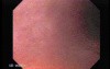 Pill Esophagitis - 2/5