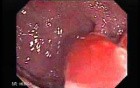 Multiple Adenomatous Polyps Of The Rectum (1 of 37)