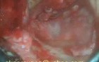Revision Mastoidectomy Part 4: Fascia Grafting, Ossiculop