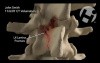 Pre-Op and Post-Op Volumations of the Lumbar Spine