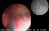 Stone In The Lower Calyx - Nephrolithotripsy