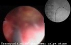 Stone In The Lower Calyx - Nephrolithotripsy