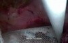 Incisional Hernioplasty - SILS
