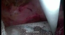 Incisional Hernioplasty - SILS